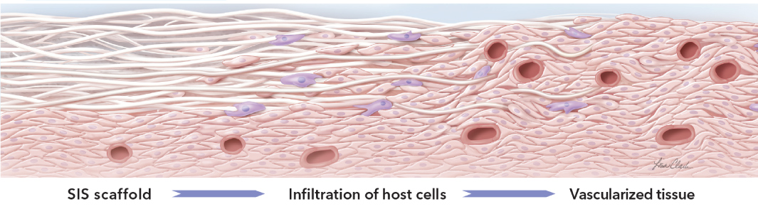 SIS tissue remodeling