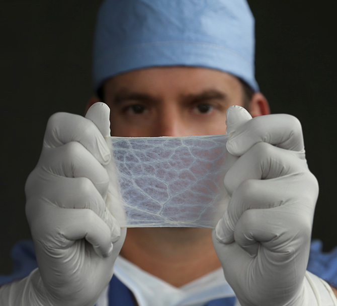 SIS Dural graft