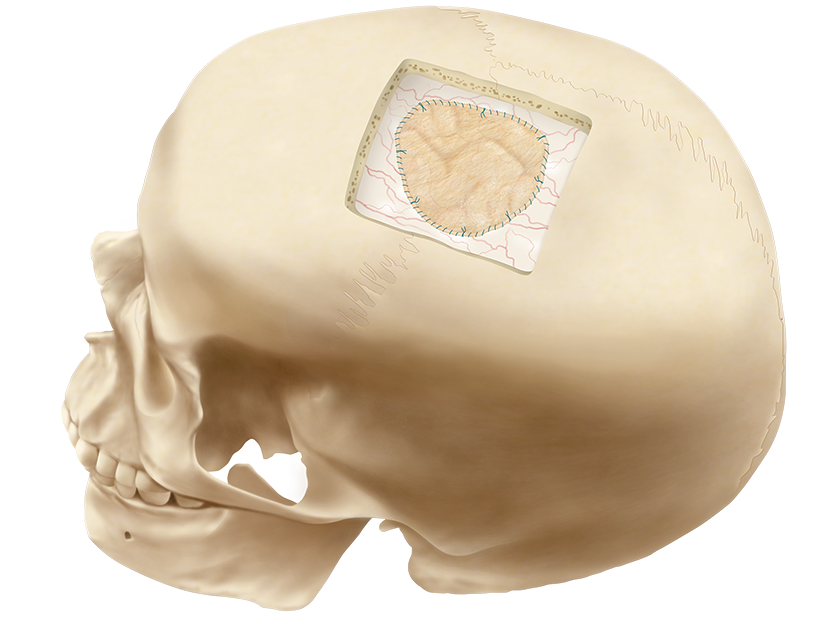 Skull with Durasis